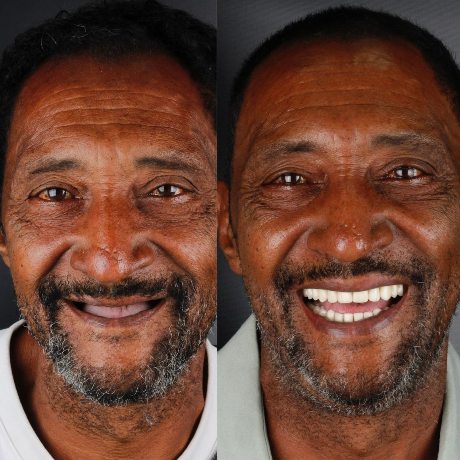 Antes e depois - Protocolo Dentário